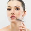 Азелаиновая кислота (Azelaic acid) Азелаиновая кислота (Azelaic acid)