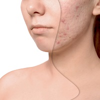 Acneol® (Акнеол, Анти-акнэ комплекс) Acneol® (Акнеол, Анти-акнэ комплекс)